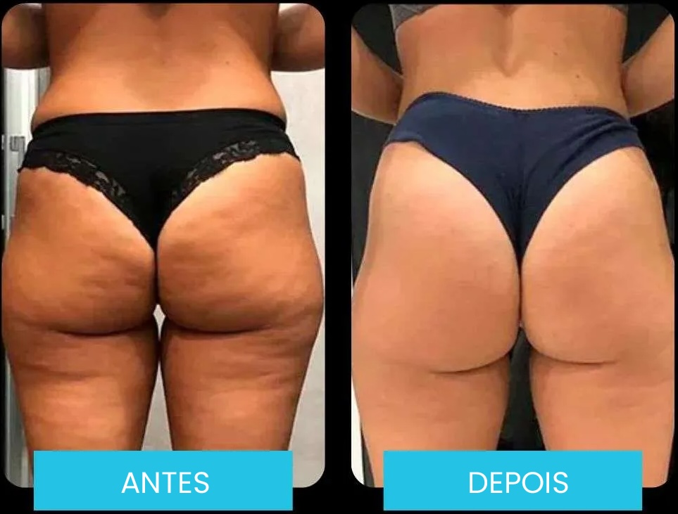 Antes e depois